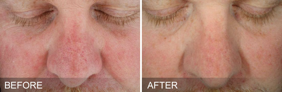 before-after-SunDamage